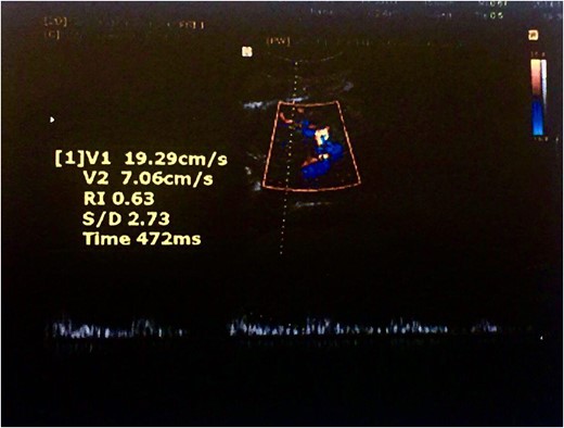 Color Doppler ultrasound of the transplanted kidney 2 months after surgery in the zoomed area of the image.