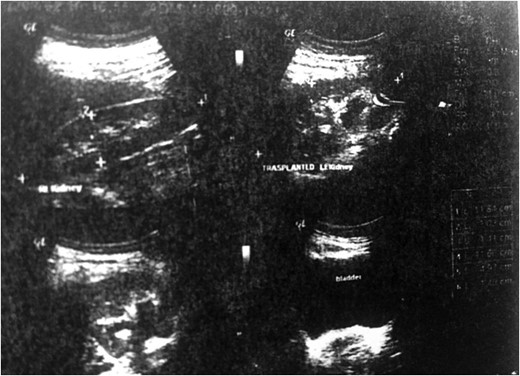 Gray-scale ultrasonography of the patient's transplanted kidney 8 months after surgery.