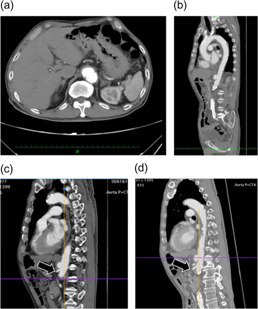 Preoperative enhanced computed tomography. (a and b) A saccular aneurysm can be observed on the descending aorta. (c) The aneurysm is very close to the celiac artery (arrow: origin of the celiac artery). The length of the celiac trunk is 11 mm. (d) The distance to the SMA is 21 mm (arrow: origin of the SMA). No endoleaks were noted in the aneurysm.