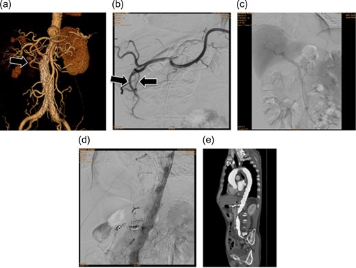 (a) Preoperative three-dimensional computed tomography (3D-CT) angiography showing the aneurysm. An arcade for the celiac and superior mesenteric arteries was confirmed via the gastroduodenal artery (arrow). (b) Intraoperative image of the celiac artery. As on the 3D-CT images, an arcade via the gastroduodenal artery was confirmed (arrow). (c) Portal phase image of the SMA. The liver is imaged during blood flow from the portal vein, confirming that the liver will be supplied with blood even if the hepatic artery blood flow decreases. (d) Angiography after placing the stent graft. No endoleaks, including Type II endoleaks from the celiac artery, are observed. Accordingly, the treatment was deemed effective. (e) Postoperative contrast-enhanced CT. No endoleaks are observed, so the treatment was considered successful.