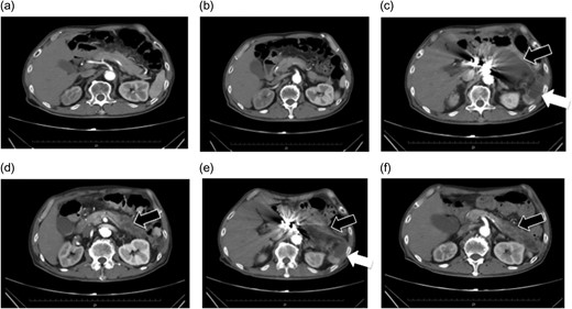 (a and b) Preoperative contrast-eCT. (c and d) eCT performed on postoperative day 13. A cyst is seen on the pancreatic tail (black arrow), while no contrast effect is seen in the spleen (white arrow). (e and f) CT performed on postoperative day 21. The pancreatic cyst has started to shrink. Part of the spleen becoming necrotic does not conflict with an etiology of ischemia due to embolization of the splenic artery.