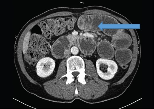 The abdominal computerized tomography showed small bowel obstruction with dilated small bowel loops (arrow).
