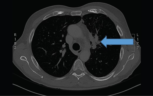 The chest computerized tomography scan showed a infiltrating tumor mass at the upper left lung (arrow).