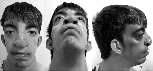 Preoperative evaluation showing bilateral cleft lip and palate, hypertelorism, low-set prominent ears and midfacial hypoplasia.