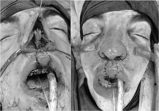 Intraoperative findings with correction of cleft lip and rhinoplasty.