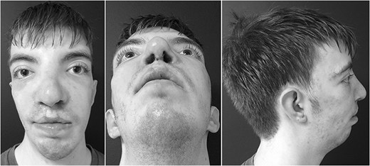 Postoperative results.