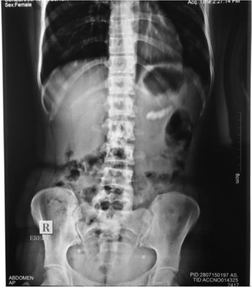 Radiograph showing multiple radio-opaque shadows corresponding to the distal part of pancreas.