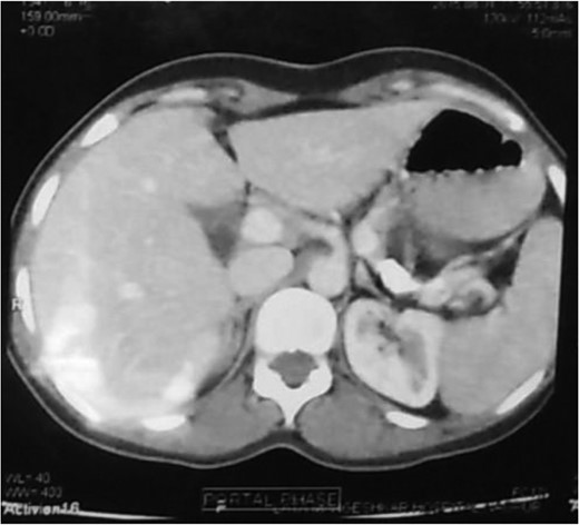 Intra-operative photograph showing frank pus on opening of pancreatic duct.