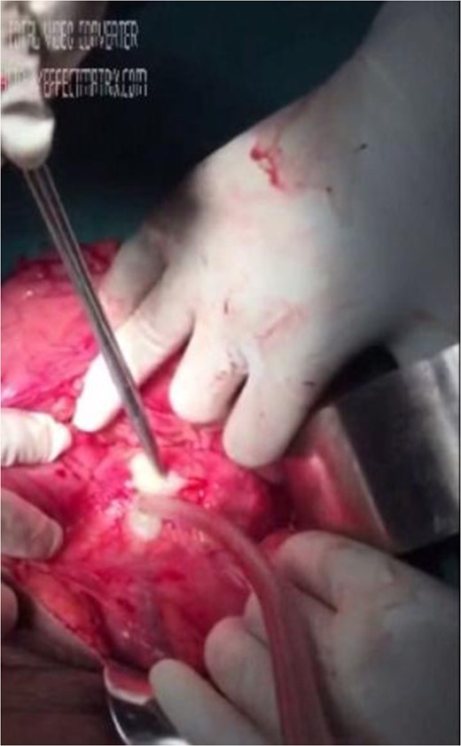 CT scan showing multiple conglomerated calcifications at the tail of pancreas.