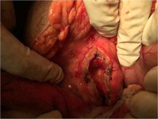 Intra-operative photograph showing main pancreatic duct after draining the pus.