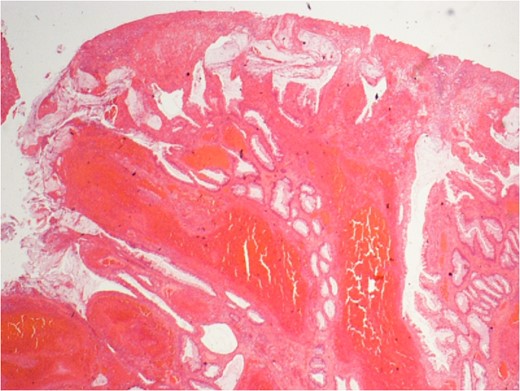 Extensive mucosal ulceration, mucosal prolapse and reactive glandular atypia.