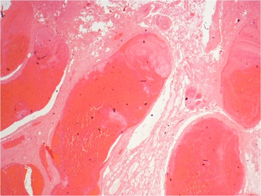 Vascular congestion and grossly dilated veins (haemorrhoids) with early intraluminal thrombus formation.