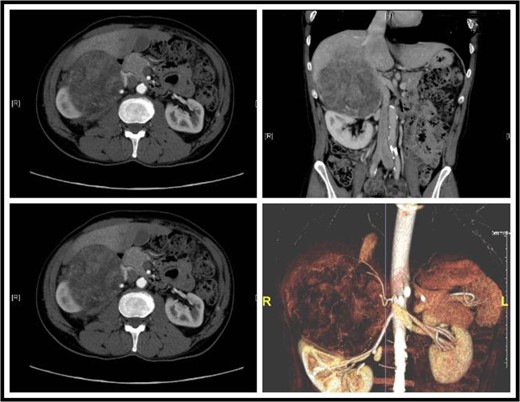 Sections of the CT showing a large retroperitoneal mass, focal absence of fat gland and an invasion into the liver.