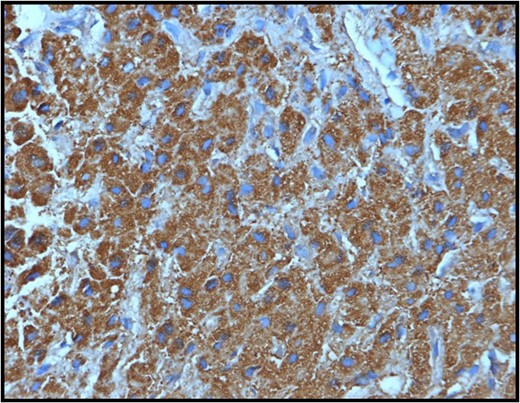 Section from the hepatic mass showing positive staining of the tumor cells with the hepar IHC stain confirming the hepatic nature of the liver mass.