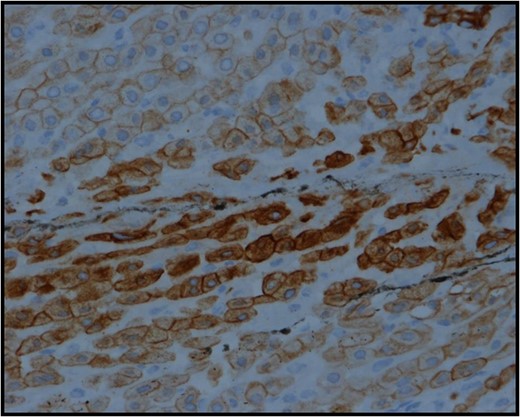 Section from the adrenocortical mass showing strong positive cytoplasmic staining with low molecular weight cytokeratin-cam 5.2 IHC stain.