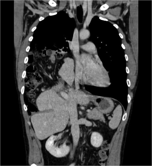 Thorax and abdominal CT showing the dislocation of right upper abdominal viscera