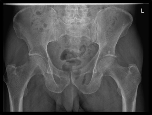 Pelvic X-ray showed a gas shadow over left obturator foramen.