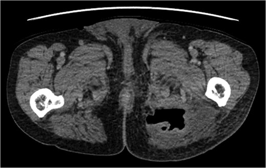 Enhanced CT showed an abscess in left gluteus maximus muscle.