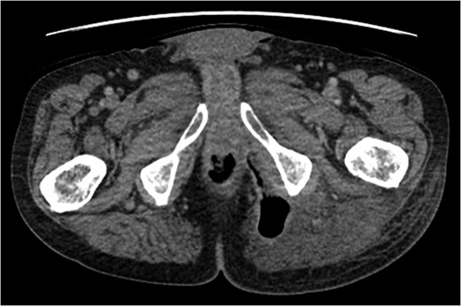 Fistula tracking to peri-anal margin.