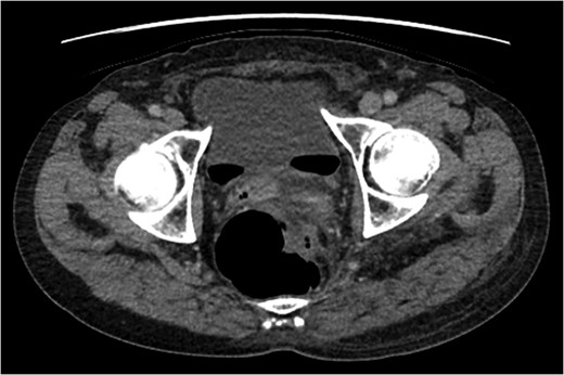 Evidence of colo-vesical fistula (free air in bladder).