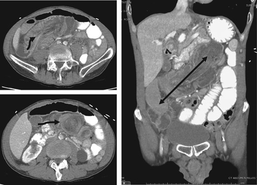 Top left: origin (arrow) of invagination in the right lower quadrant. Bottom left: the classic ‘target sign’ (arrow). (Right) Coronal demonstrating the extent of intussusception.