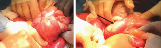 Left: stills from intraoperative video recording demonstrating the reduction of the intussusception in order to explore the lead point. Right: ischemic terminal ileum (arrow) and palpation of the lead point at the ileocecal valve.