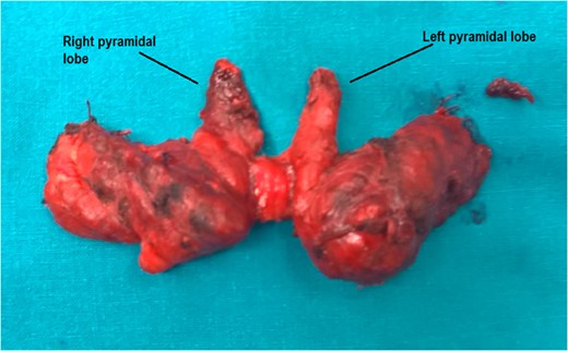 The DPLs of the thyroid gland.