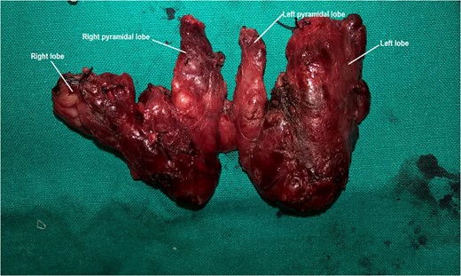 : Total resection of the thyroid gland. All the four lobes and the isthmus are detected. Nodules of the thyroid parenchyma are visible.