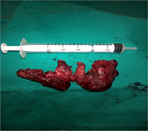: A crude measurement of the thyroid gland size.