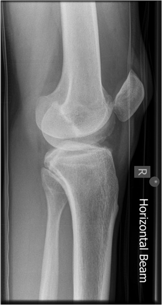 Lateral radiograph of knee showing dislocated patella.