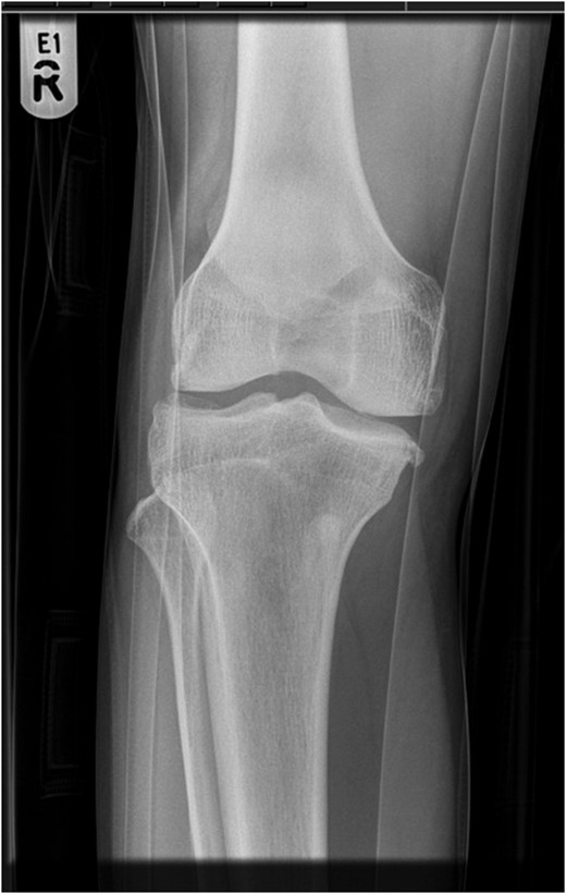 AP radiograph of knee.