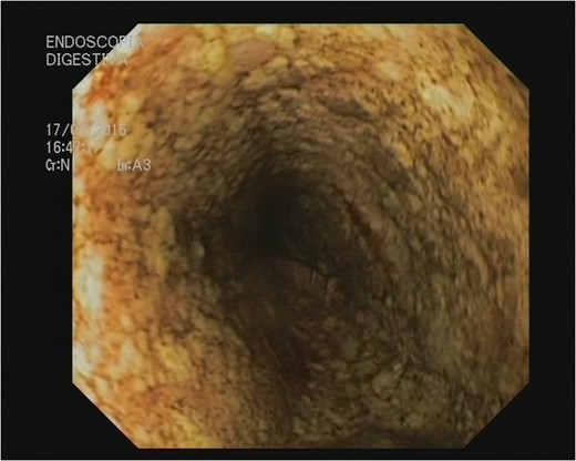 Black esophagus: AEN.