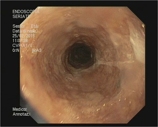 Esophageal re-epithelization.