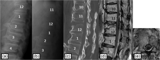 Plain radiographs on initial assessment (a) and on admission (b); Sagittal CT image (c) showing the hyperextension fracture at T12; MRI T2-weighted image (d, e) showing the epidural hematoma compressing the dura matter.