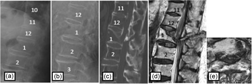 Plain radiographs on initial assessment (a) and on admission (b); Sagittal CT image (c) showing the hyperextension fracture at L1 and dislocation of it; MRI T2-weighted image (d, e) showing the severely compressed spinal cord at L1 level.