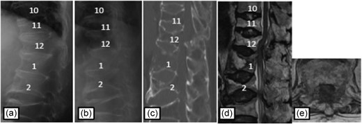 Plain radiographs on initial assessment (a) and on admission (b); Sagittal CT image (c) showing the hyperextension fracture at L1 and dislocation of it; MRI T2-weighted image (d, e) showing the severely compressed spinal cord at T12 level.