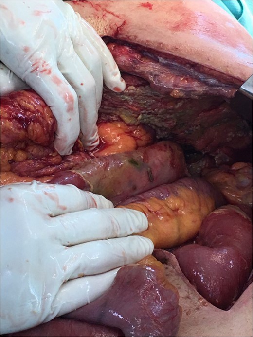 Multiple areas of patchy necrosis along the small intestine.