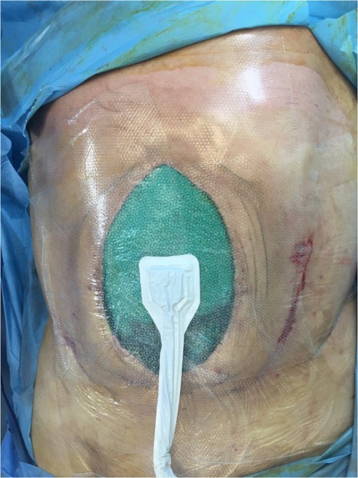 Open abdomen with a vacuum device.