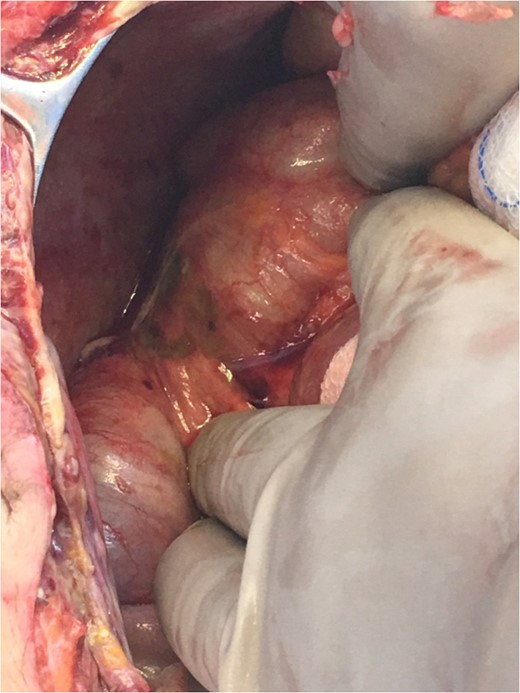 Necrotic lesion on the cecum.