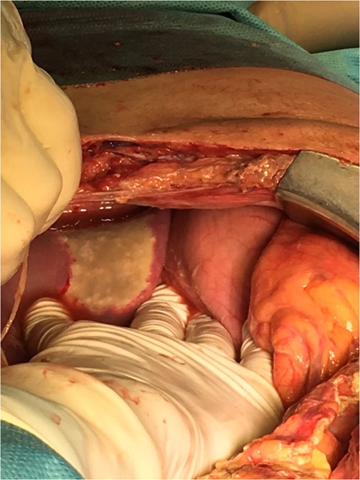 Necrotic lesion on the left lobe of the liver.