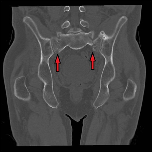 Bilateral sacral fractures (in line with arrows) are clearly visualized on the coronal reformat of CT pelvis.