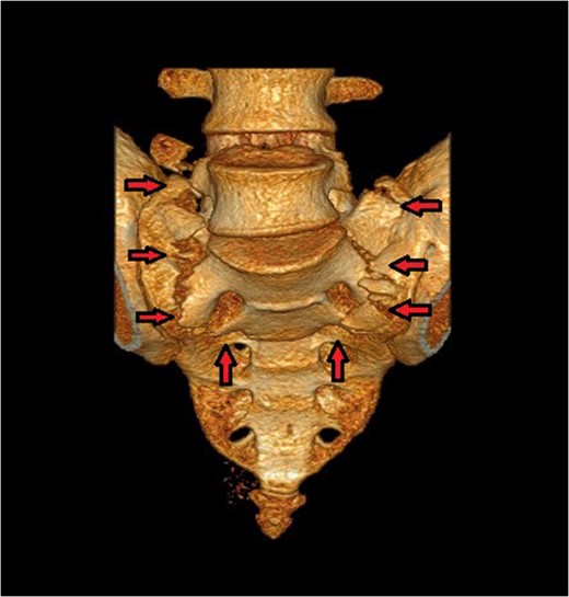 The U-type pattern with spino-pelvic dissociation is better appreciated on the 3D reconstruction of CT pelvis.
