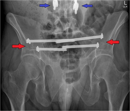 The post-operative X-ray pelvis shows the bilateral ilio-sacral fixation with percutaneous screws (red arrows). Note the inferior portion of the patient's pre-existing thoracolumbar instrumentation (blue arrows) that precluded spino-pelvic fixation as a viable surgical option in this case.