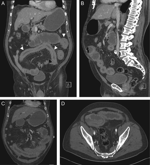 Coronal (A, C), sagittal (B) and axial (D) CT showing small bowel intramural haematoma up to the mid-ileum with associated oedema causing obstruction and proximal small bowel and gastric dilatation.