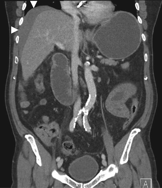 Coronal CT showing haemoperitoneum adjacent to the liver.