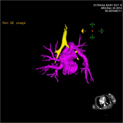CT 3D showing anterior heart highlighting anomalous venous return (pink). The left venous vertical vein is shown passing over the left mainstem bronchus (yellow) as it enters the heart.
