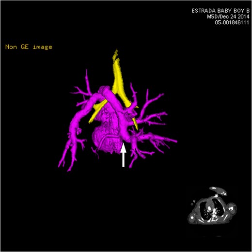CT 3D showing posterior heart highlighting anomalous venous return (pink). Multiple pulmonary vein branches are shown conjoining together to form the left-sided vertical vein (white arrow). It dips under the carina and loops back over the left mainstem bronchus (yellow).