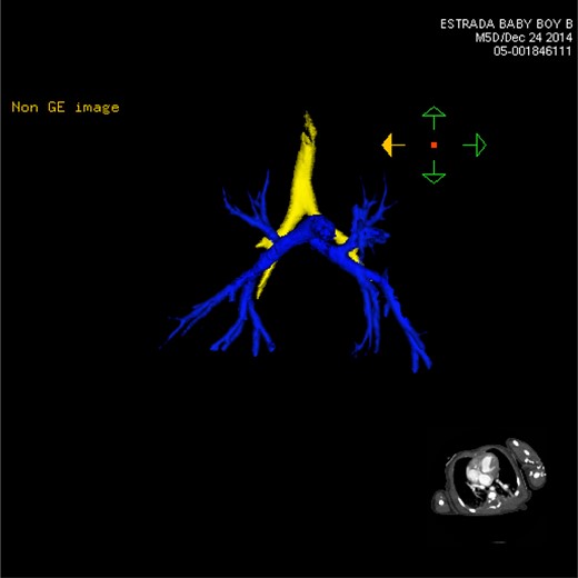 CT 3D showing anterior pulmonary arterial circulation (blue). Both left and right branches are nearly identical, characterized by the two right-sided lungs.