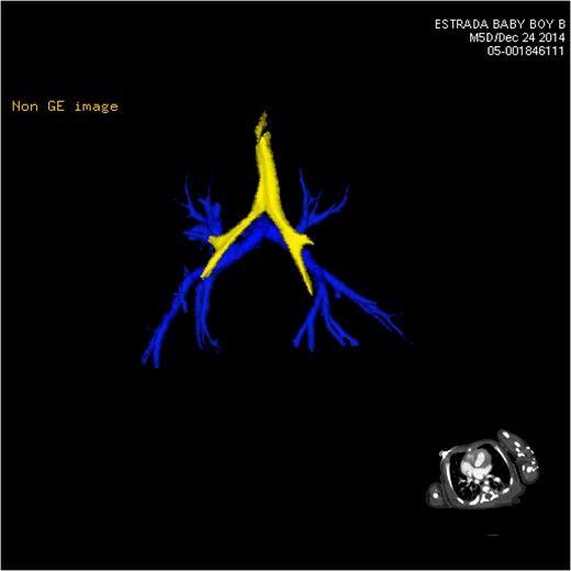 CT 3D showing posterior pulmonary arterial circulation (blue).