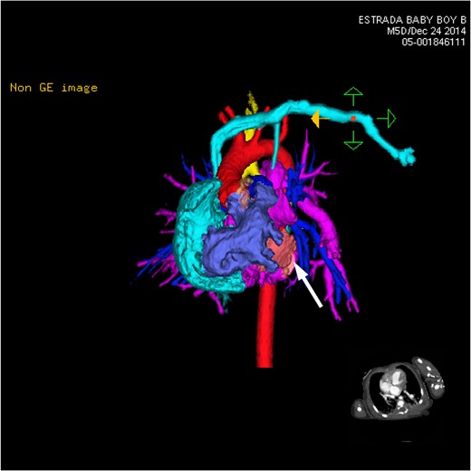 CT 3D showing anterior heart and circulation. The left-sided subclavian vein (light blue) brings blood to the right atrium (light blue). The right ventricle (dark purple) provides outflow to both the aorta (red) and the pulmonary arteries (dark blue). The multiple branches of the pulmonary veins (pink) can be seen coming together and wrapping over the left mainstem bronchus. The hypoplastic left ventricle (white arrow) can be seen small and shrunken slightly to the left of the large right atrium.